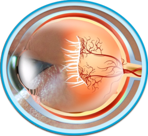 How is ROP diagnosed and staged? – ROP | Patient & Caregiver